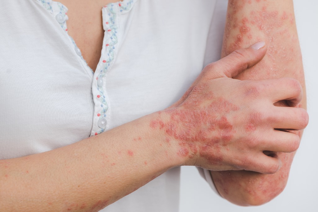 Psoriasis Awareness in Seniors: Understanding, Managing, and Supporting Skin Health